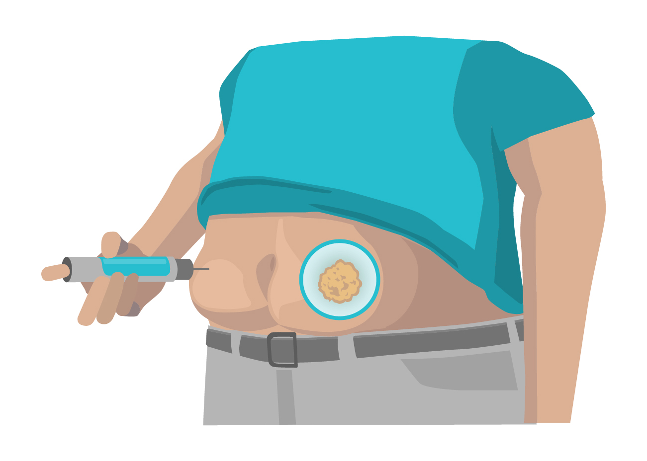  Injektion in eine Lipohypertrophie im Bauchbereich.